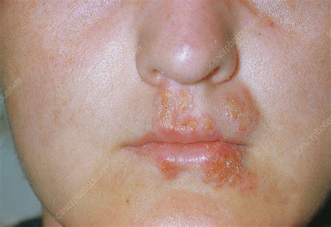 Herpes simplex sores on lip & mouth - Stock Image - M170/0089 - Science ...