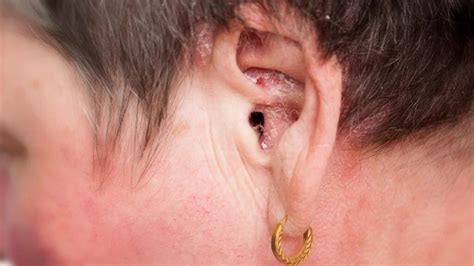 Psoriasis in the ears: Treatment and symptoms