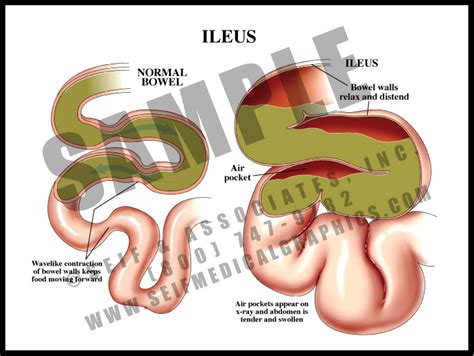 Ileus - S&A Medical Graphics