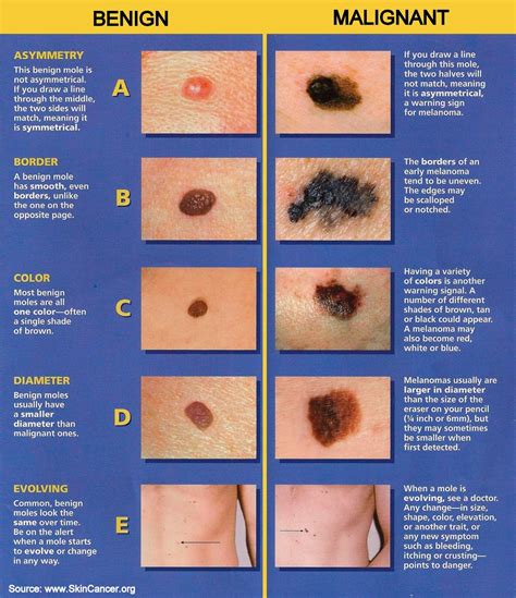 ABCDEs of Melanoma