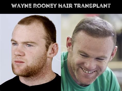 Wayne Rooney Hair Transplant Before And After