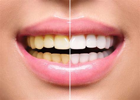 7 Teeth Whitening Options: Which Ones Work Best? - University Health News