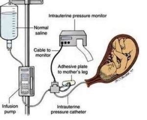 Amnioinfusion - Indications, Procedure, Complications, Define