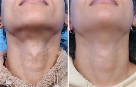 UCSF Surgeons Develop Effective Scarless Adam’s Apple Surgery | UCSF ...