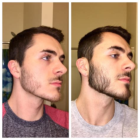 Minoxidil Before And After Beard Result - Can Rogaine (Minoxidil) Make ...