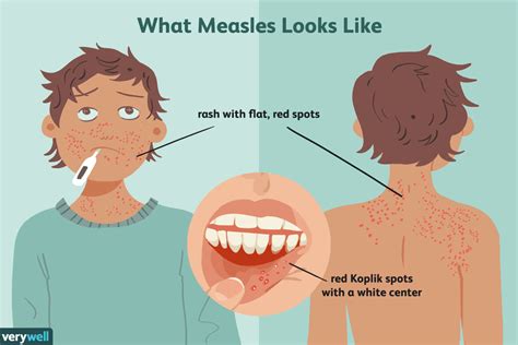 Measles Prevention