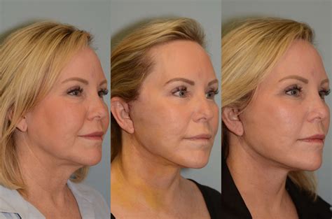 Facelift, Neck lift Houston