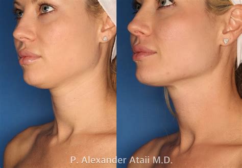 Ultherapy Gallery Before & After Photos | Laser Cliniqúe