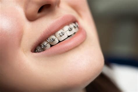 Why You Should Consider Trying Traditional Braces? | Fabbricabois