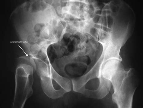 Acetabulum Fracture