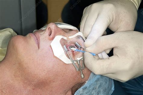 Laser eye surgery - Stock Image - C007/8411 - Science Photo Library