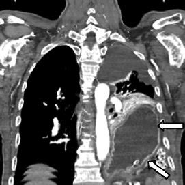 (PDF) Laparoscopic Repair of Bochdalek Diaphragmatic Hernia in Adults