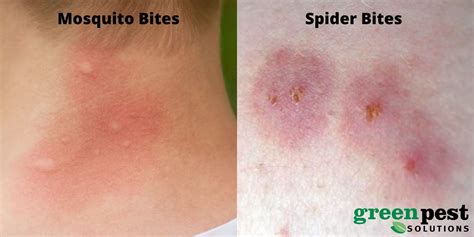 Why Do Bug Bites Get Itchy At Night at Karen Matthias blog