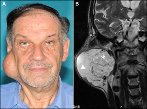 Pleomorphic Adenoma of the Parotid Gland - The American Journal of Medicine