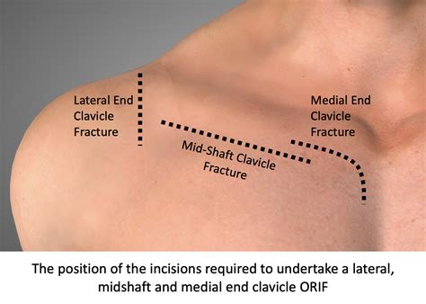 Clavicle Sternal End