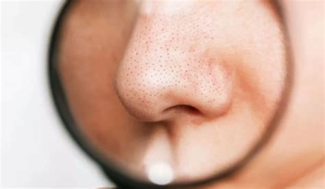 Best Blackhead Removal Tools For Instant Results You Should Try!