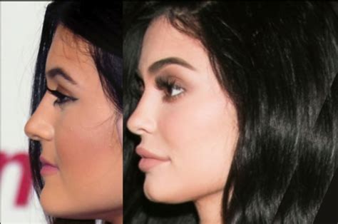 Kylie Jenner Before and After ? All of her Plastic Surgery!