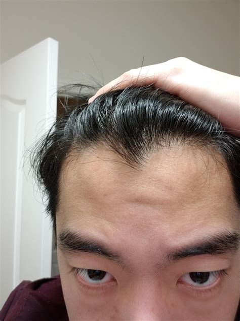 Is this early signs of a receding hairline? : r/malehairadvice