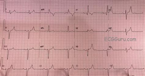 Bifascicular Block and Sinus Bradycardia | ECG Guru - Instructor Resources