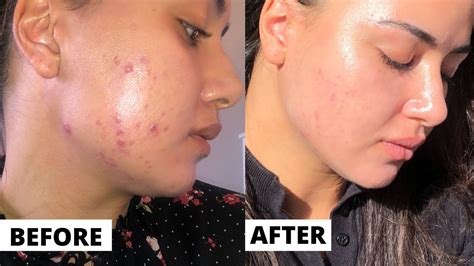 Tretinoin 3 month Update (FAITH RESTORED!! ) Tretinoin Before And After ...