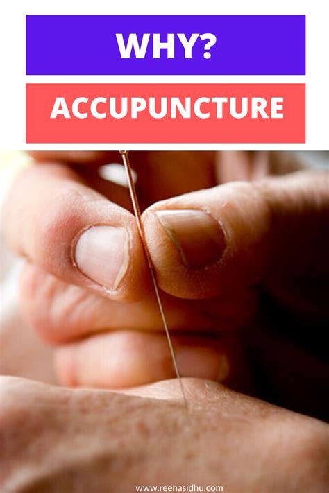 The Many Benefits Of Acupuncture