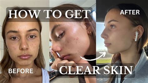 HOW TO GET CLEAR SKIN: the skincare routine that got rid of my acne ...