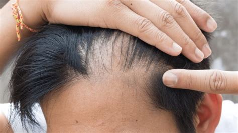 Receding Hairline Meaning, Types, Causes, Regrowth Treatments and ...