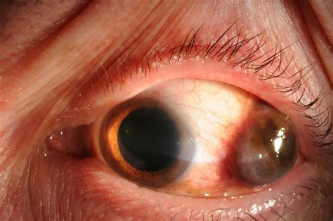 Moran CORE | Conjunctival Melanoma