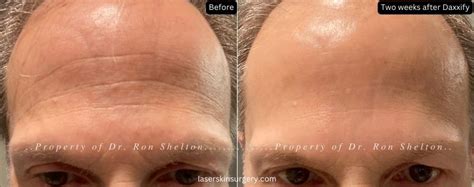 Daxxify vs Botox Cosmetic to reduce forehead frown lines in NYC