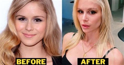 Erin Moriarty Plastic Surgery: Did The Boys Star Have Cosmetic Procedures?