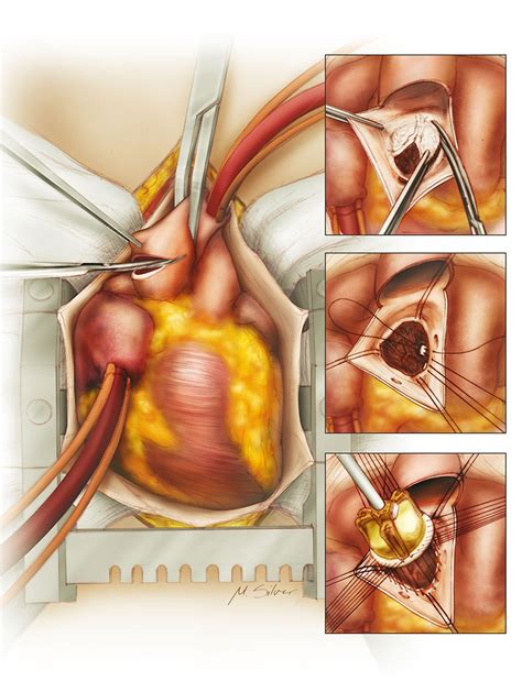 Aortic Valve Replacement | Silver Medical Visuals