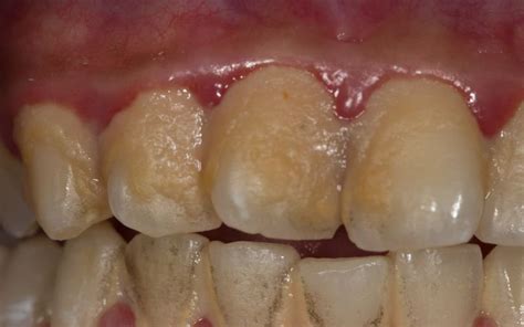 Bacterial plaque: Find out what it is and how you can fight it🦷 — ProDent