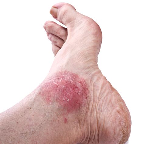 Is Your Foot Rash Psoriasis? | Syracuse Podiatry - Dr. Ryan D'Amico