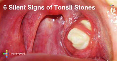 Symptoms Of Tonsil Cancer