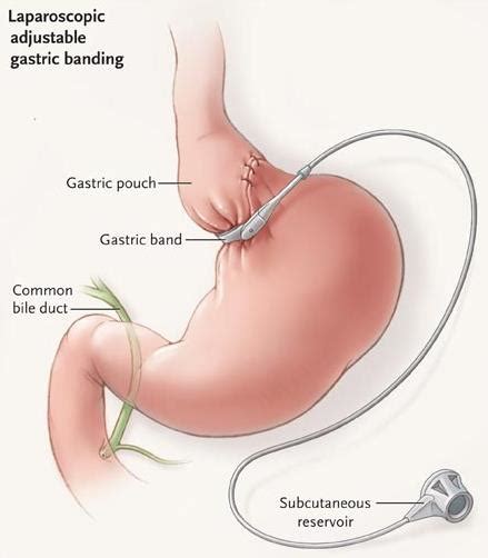 Adjustable Gastric Band (AGB) – Penn Medicine