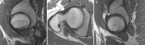 Diagnostic Imaging of the Hip for Physical Therapists - Physiopedia