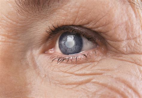 Cloudy Vision? You Could Have Cataracts - Buffalo Healthy Living Magazine