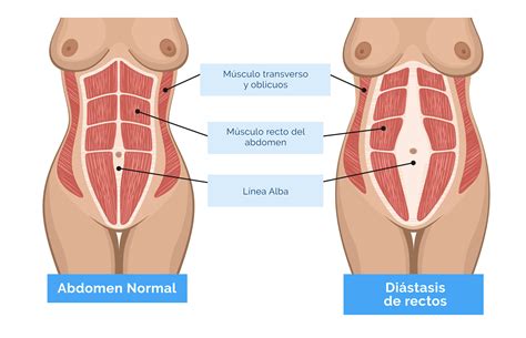 Linea Alba Hernia