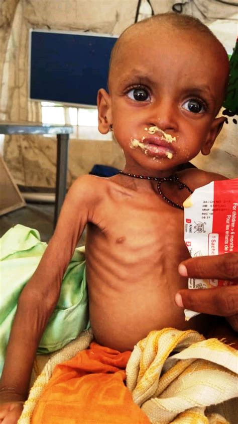 Malnutrition causes nearly half of all child deaths -UNICEF