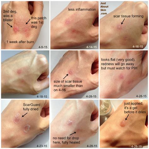 Burn Scar Treatment Case Study - How I Treated A Burn Scar With ...