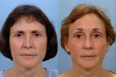 Facelift und Mini-Facelift | Johns Hopkins Facial Plastic and ...