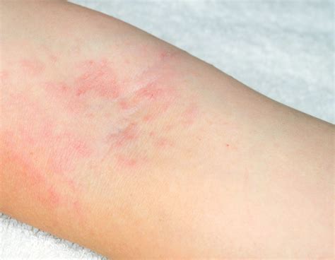 Skin Rashes On Body