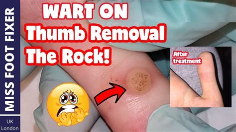 Wart On Thumb Removal Full Treatment By Miss Foot Fixer - YouTube