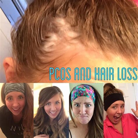 Can You Stop Hair Loss With Pcos - Best Simple Hairstyles for Every ...