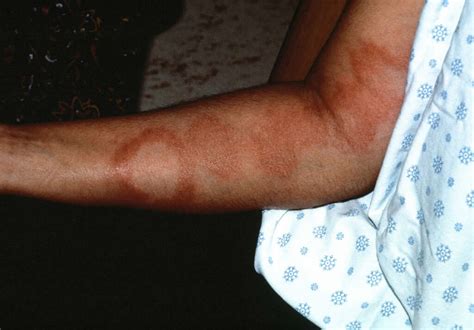 Leprosy: What Is Leprosy?