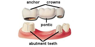 Dental Bridges, a Complete Overview