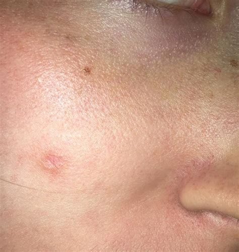 hole like crater scar – Scar treatments – Acne.org Forum