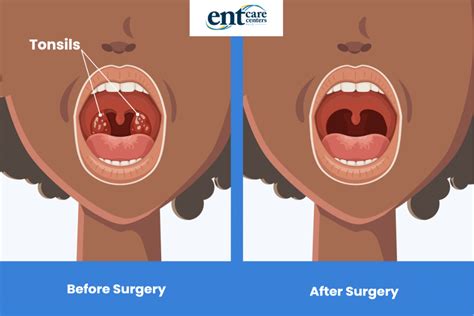 Tonsillectomy - Louisville, Elizabethtown & La Grange KY, Corydon IN