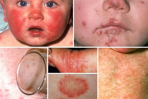 From meningitis to eczema and measles... the ultimate baby rash guide ...