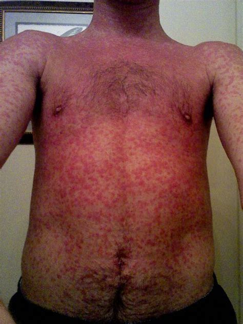 Rash associated with Epstein Barr Virus infection Nurse Stuff, Skin ...